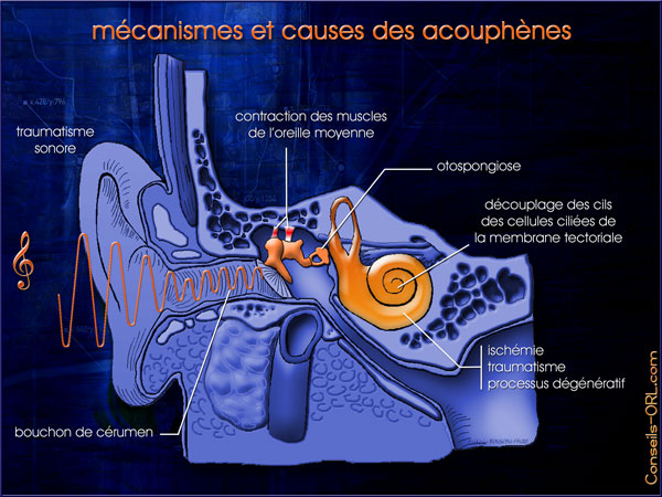 La maladie de Menière - La page principale du blog - France Acouphènes